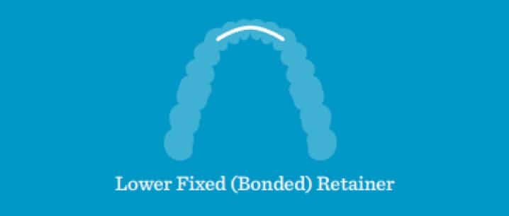 Lower Fixed or Bonded Retainers